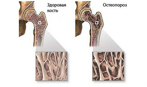 az osteoarthritis krioterápiás kezelése